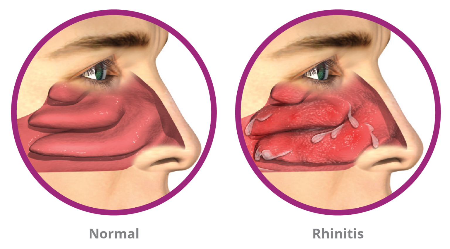RhinAer for Rhinitis - ENT Voice Center
